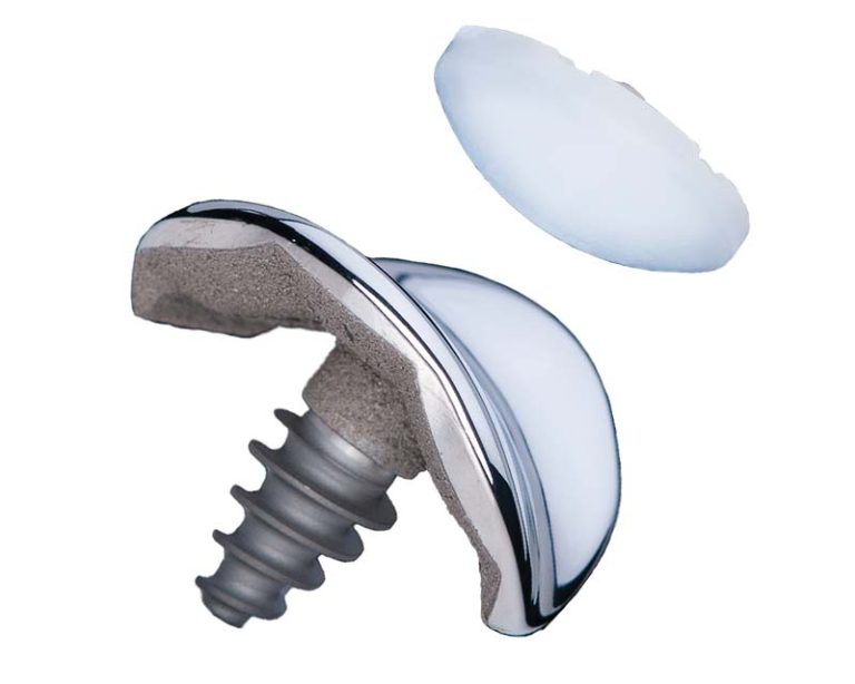 Knee Implants Total Joint Replacement Alternatives Anika