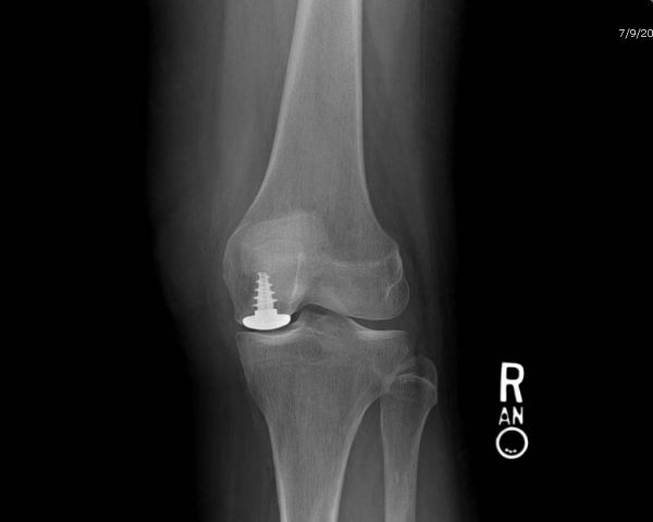 Unicompartmental Knee Arthroplasty System - Anika