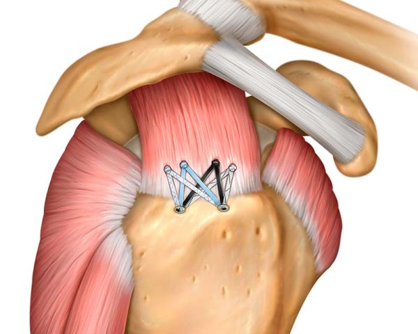 Twist And Triple Twist Peek Screw In Rotator Cuff Suture Anchor Anika