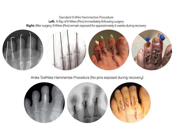 ToeMate System: Hammertoe Implant For Joint Replacement - Anika