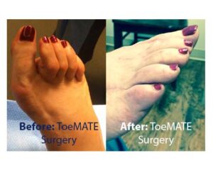 Hammertoe Surgery Hammertoe Correction Solutions Anika