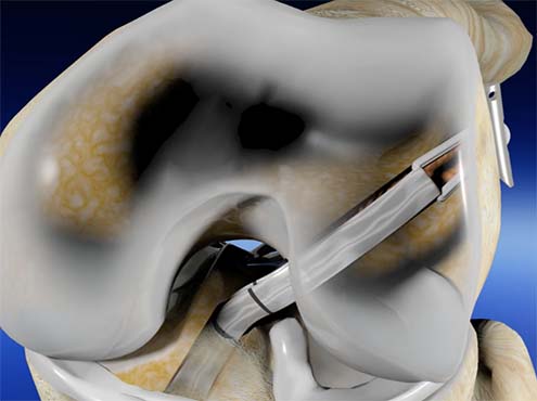 ACL Reconstruction with GFS II