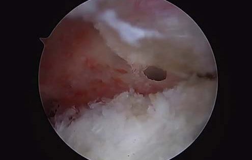 Hip Labral Repair Surgical Technique Video