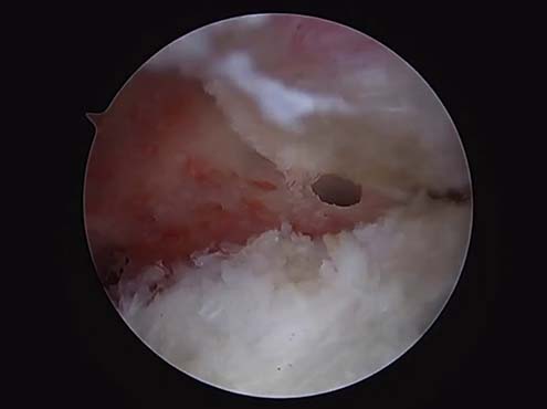Hip Labral Repair Surgical Technique Video