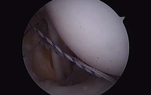 Labral Repair & Capsulorrhaphy Surgical Technique Video