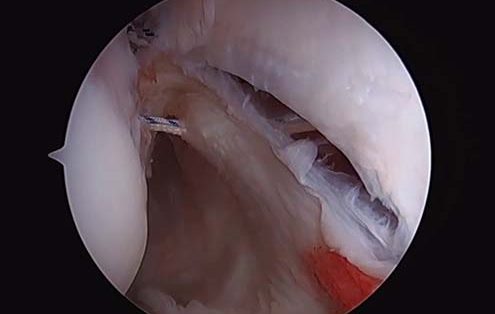 Repair of Floating Posterior Glenohumeral Ligament Surgical Technique Video