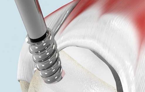 Rotator Cuff Repair with V-LoX™ PEEK CF Screw-In Suture Anchors