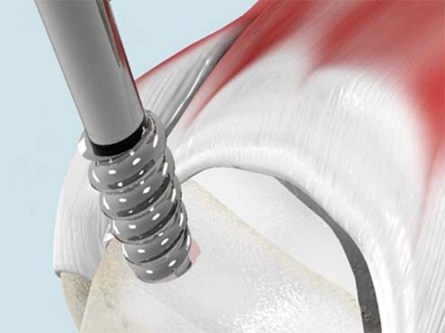 Rotator Cuff Repair with V-LoX™ PEEK CF Screw-In Suture Anchors