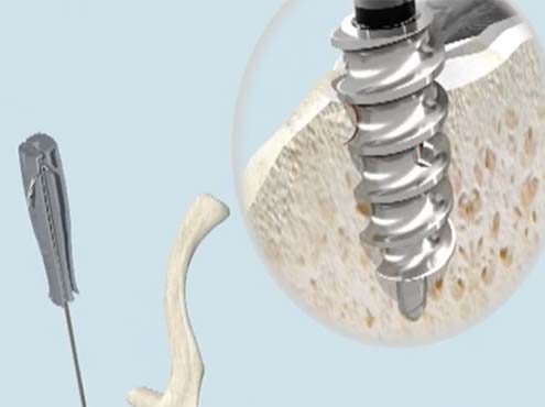 Rotator Cuff Repair with V-LoX™ Titanium Screw-In Suture Anchors
