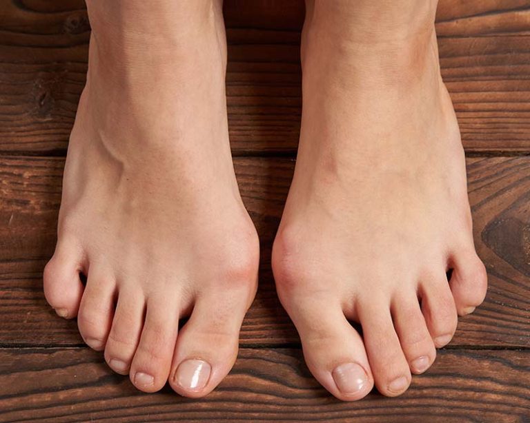 Bunion Removal Solutions And EndStage Toe Arthritis Anika