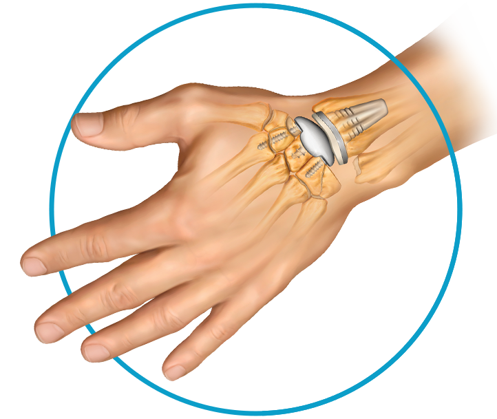 Wrist Implants
