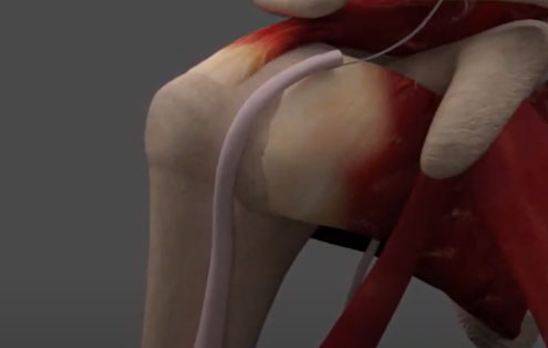 Biceps Tenodesis Repair with the SLiK Fix Screw-In Tenodesis System Surgical Technique Animation