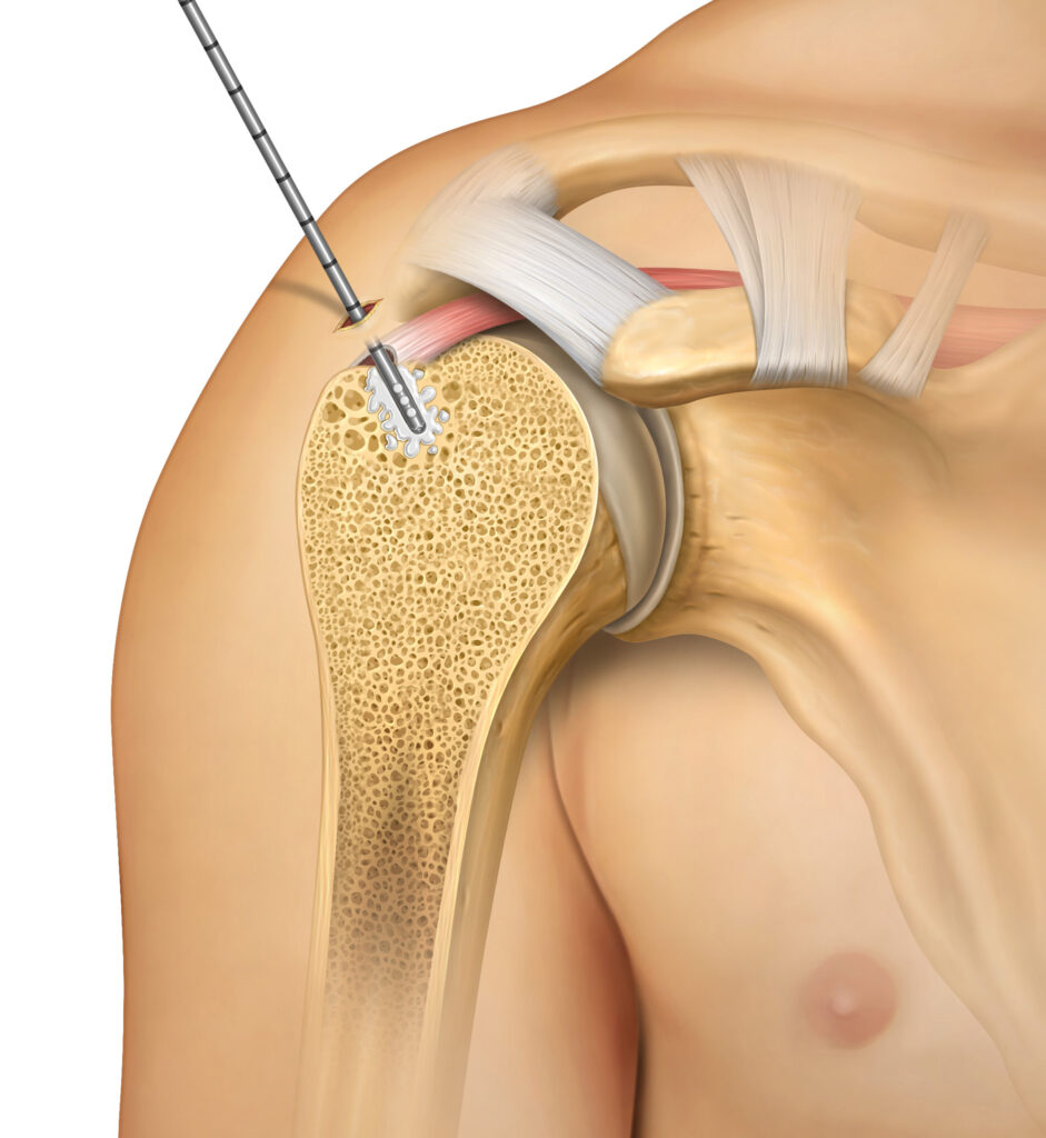 A square piece of honeycomb with white wax attached to black and blue cords or strings.