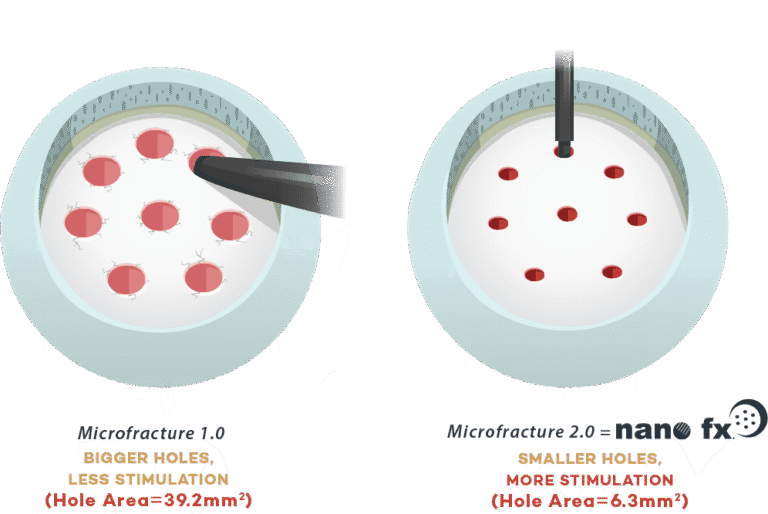 Comparison diagram showing two microfracture techniques: version 1.0 with larger holes providing less stimulation, and version 2.0 with smaller holes providing more stimulation.