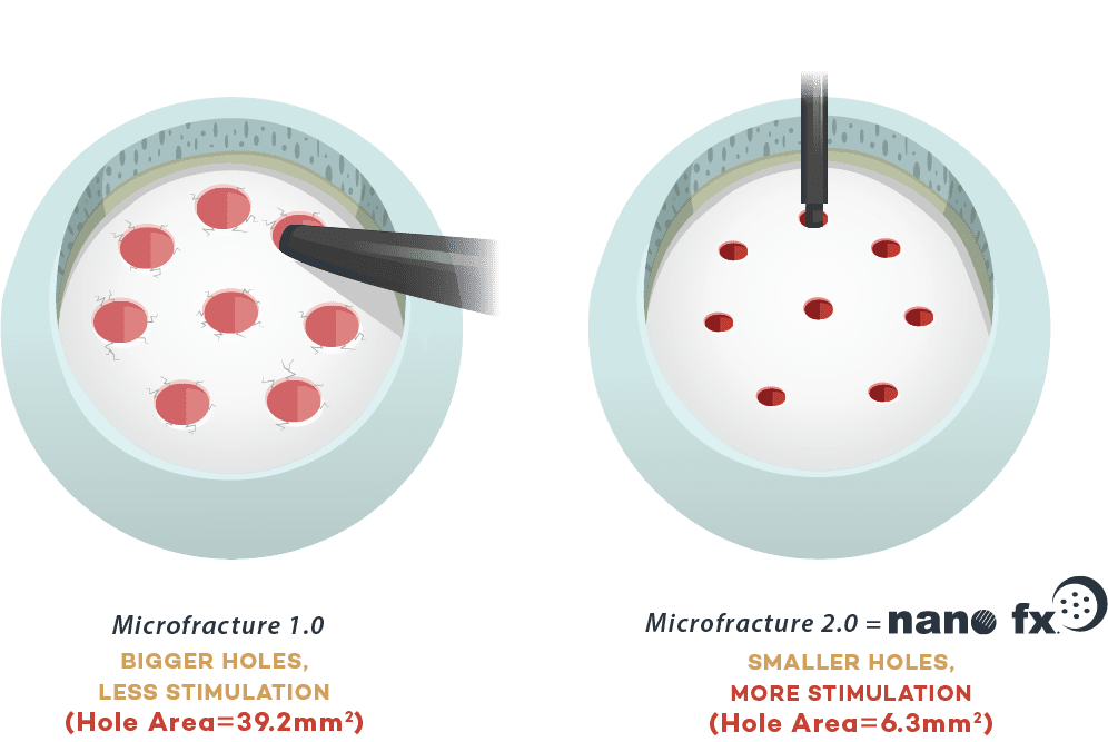 Comparison diagram showing two microfracture techniques: version 1.0 with larger holes providing less stimulation, and version 2.0 with smaller holes providing more stimulation.