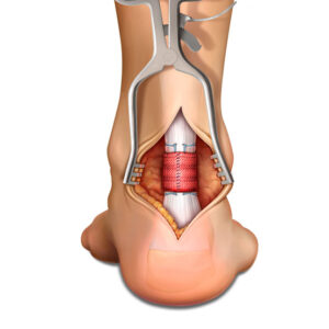 Anatomical cross-section showing Achilles tendon repair with surgical implant or device in the heel area.