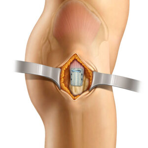 Medical illustration showing a spinal cord stimulator implant device placed in the lower back area with connecting leads.