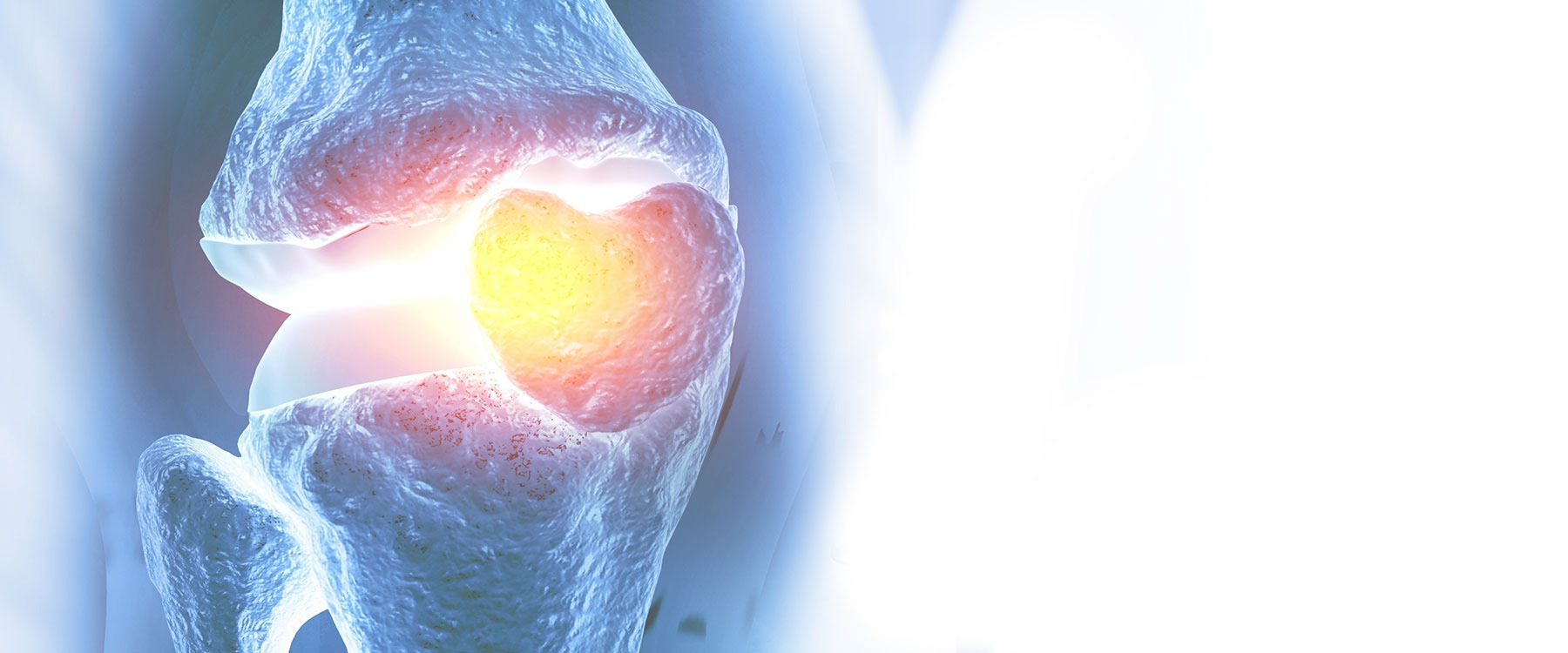 Understanding Osteoarthritis