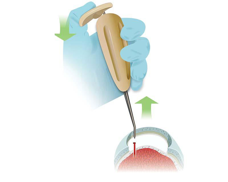 Medical illustration showing a gloved hand holding a surgical instrument performing a precision procedure on an eye.