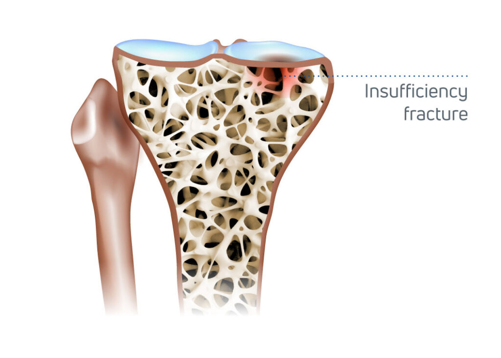 Cross-section of bone showing porous internal structure with an insufficiency fracture indicated by a red area and label.
