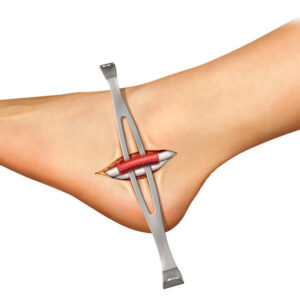 Medical illustration showing a surgical clamp holding torn muscle tissue together on an arm for repair.