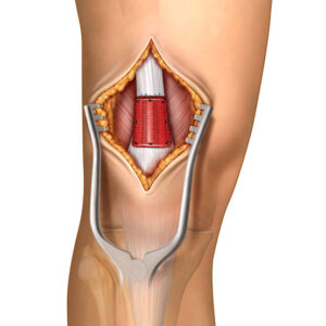 Cross-sectional medical illustration showing knee surgery with surgical instruments and a red mesh implant being placed in the joint.
