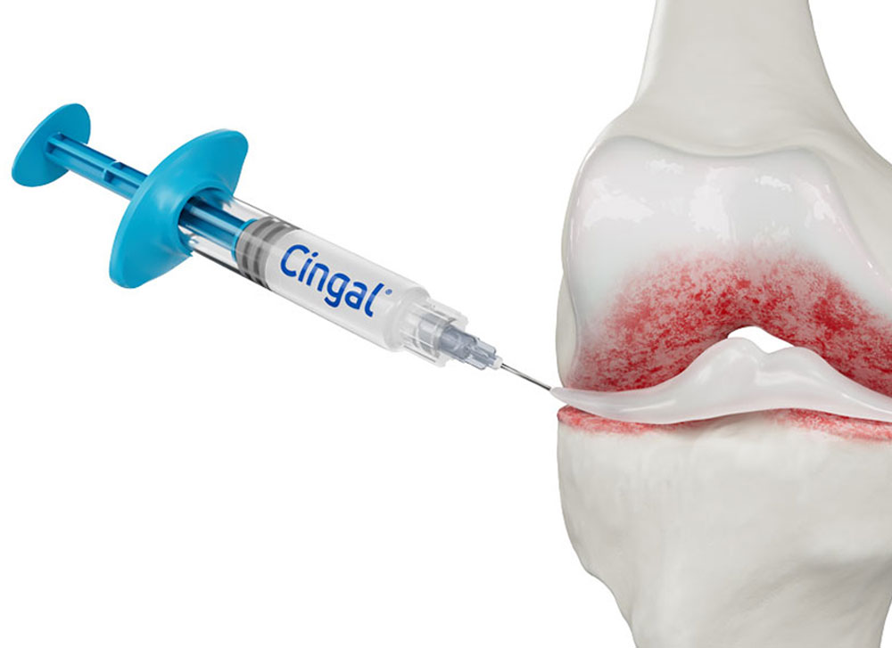 Medical syringe labeled "Cingal" being injected into a knee joint, showing the bone and cartilage anatomy.
