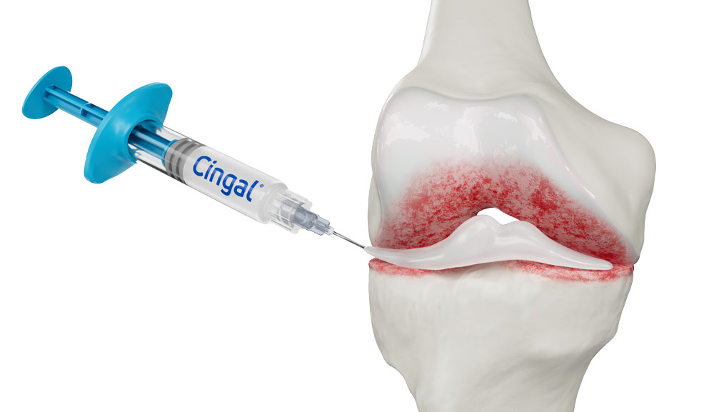 Medical syringe labeled "Cingal" being injected into a knee joint showing inflamed cartilage in red.