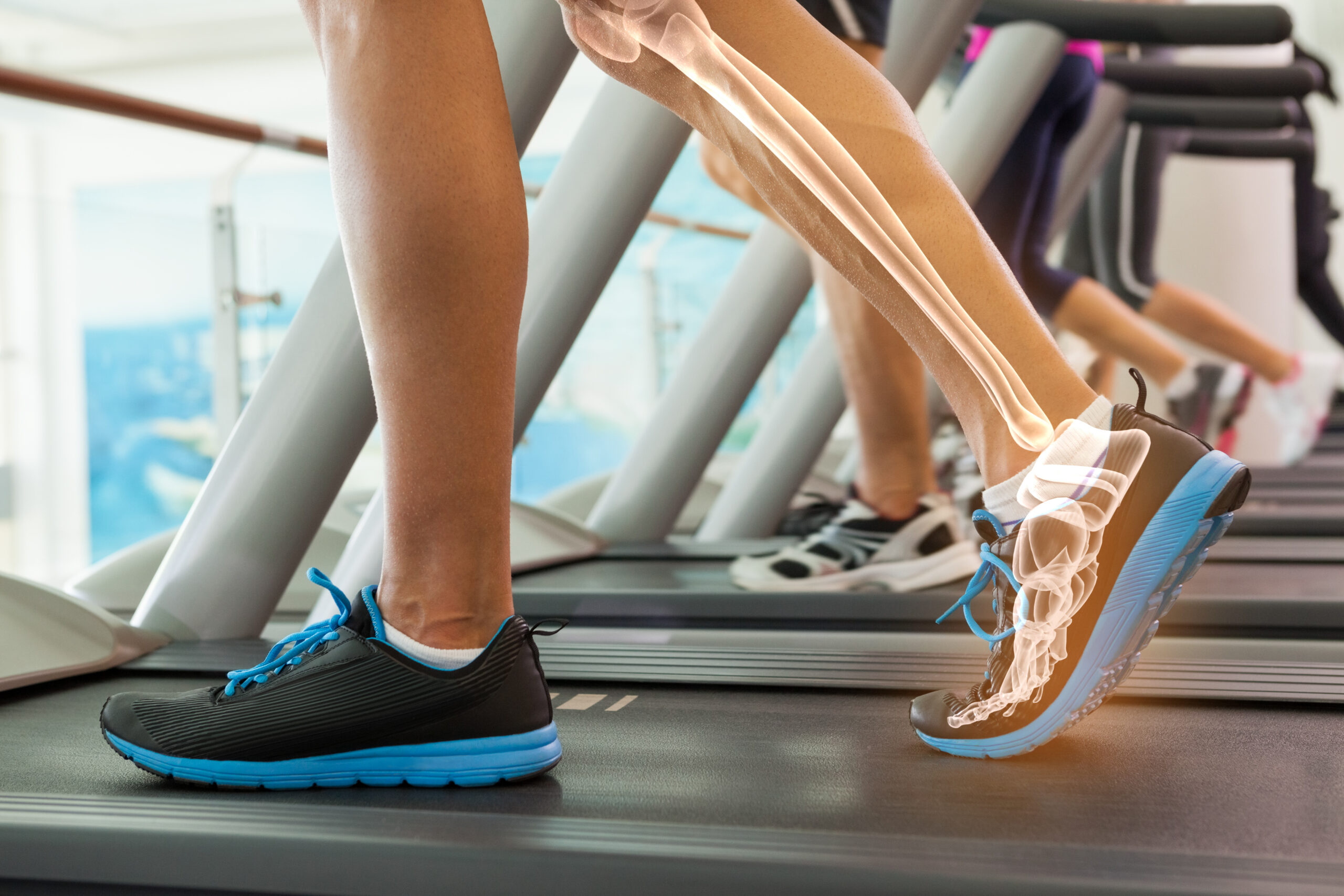 person walking on treadmill | Xray view of leg and foot.